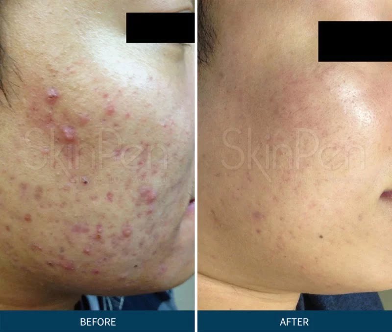 Microneedling Before & After Treatment Photos | Cosmedics MedSpa in Lehi, UT