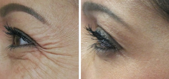 Botox Crows Before & After Treatment Photos | Cosmedics MedSpa in Lehi, UT