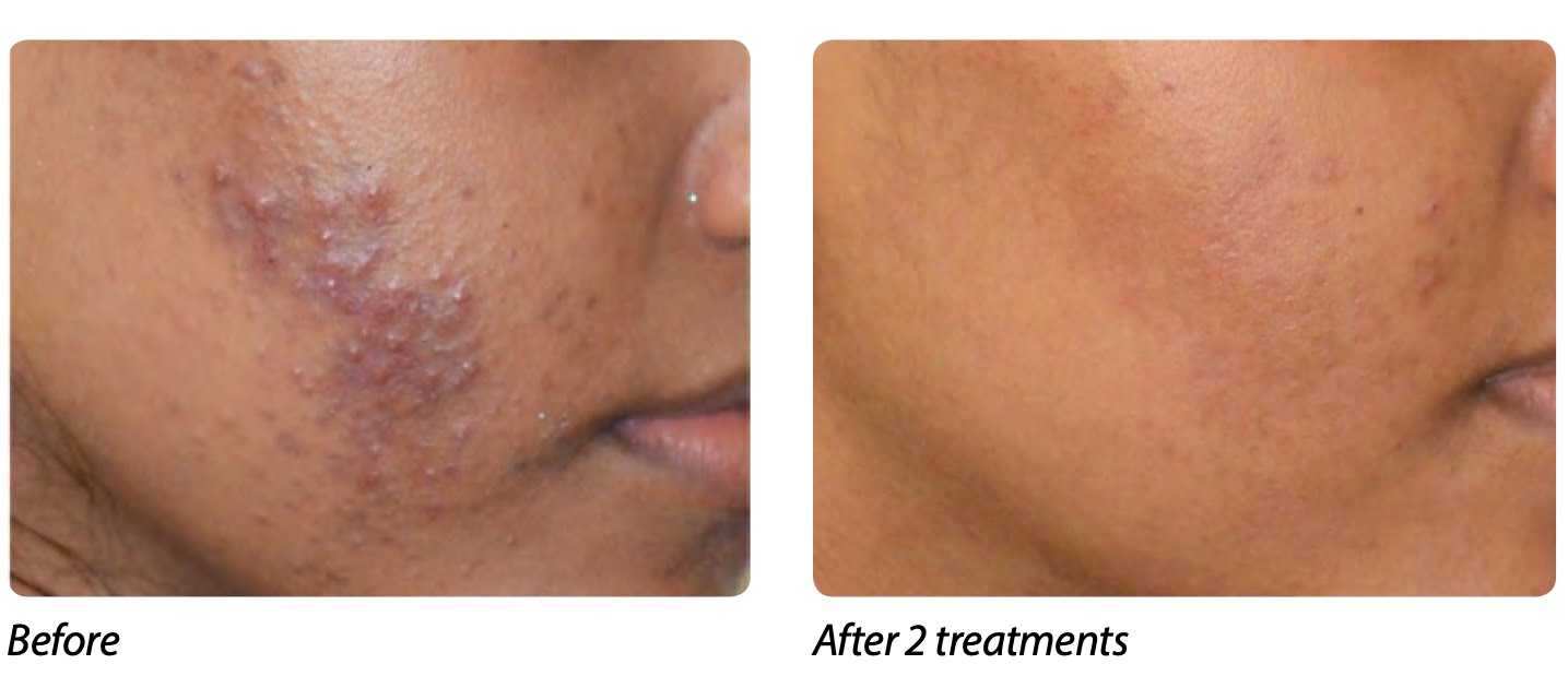 IPL Photofacial Before & After Treatment Photos | Cosmedics MedSpa in Lehi, UT