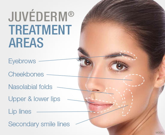 Juvederm Treatment Areas | Cosmedics MedSpa in Lehi, UT