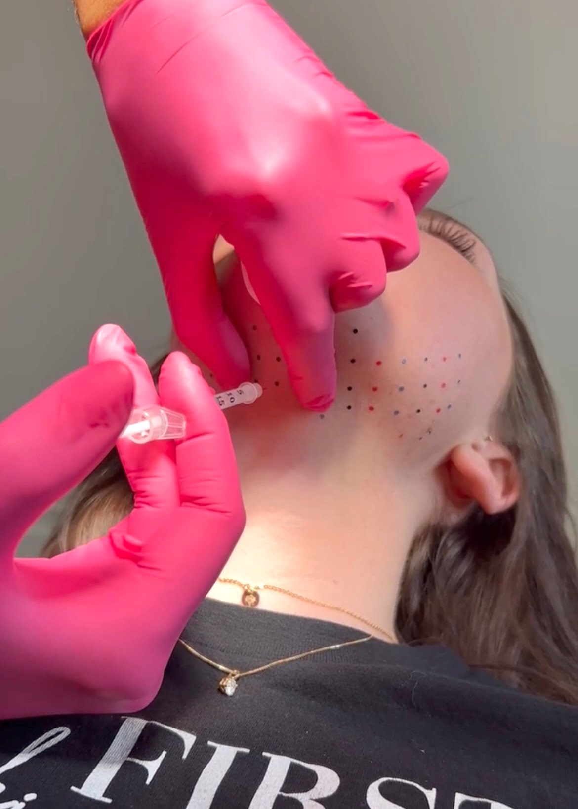 Woman Getting Kybella Treatment Close Up | Cosmedics MedSpa in Lehi, UT