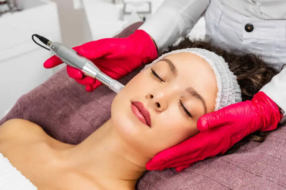 Microneedling for Stretch Marks by Cosmedics Med Spa in Lehi, UT