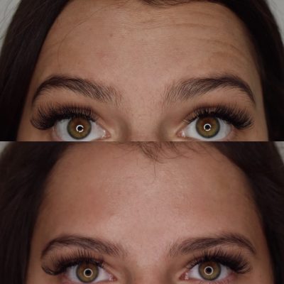 Botox Before & After Photos | Cosmedics MedSpa in Lehi, UT