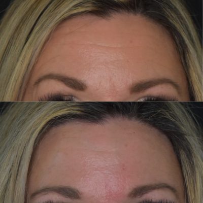 Botox Before and After | Cosmedics MedSpa in Lehi, UT
