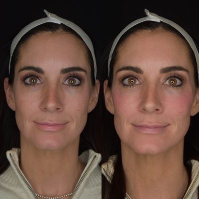 Cheek Filler Before & After Images | Cosmedics MedSpa in Lehi, UT