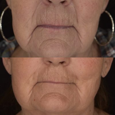 Opus Before & After Images | Cosmedics MedSpa in Lehi, UT