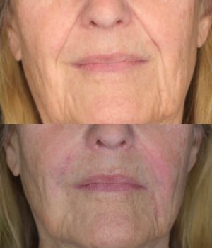 Nasolabial Fold Filler Before & After Treatment Photos | Cosmedics MedSpa in Lehi, UT