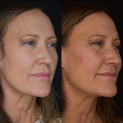 Cheek Filler Before & After Photos | Cosmedics MedSpa in Lehi, UT