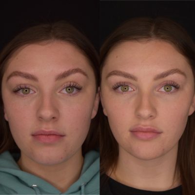 Cheek Filler Before & After | Cosmedics MedSpa in Lehi, UT