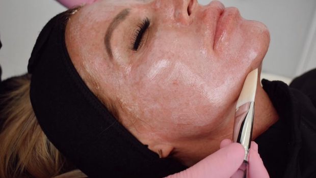 Chemical Peel Treatment | Cosmedics MedSpa in Lehi, UT