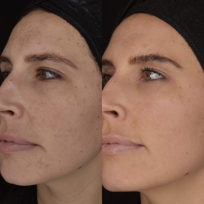 Chemical Peels Before and After | Cosmedics MedSpa in Lehi, UT