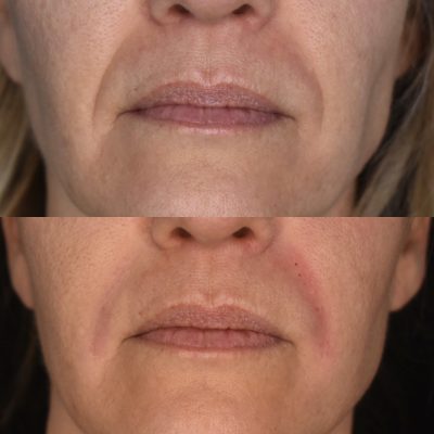 Nasolabial Fold Filler Before & After Photos | Cosmedics MedSpa in Lehi, UT
