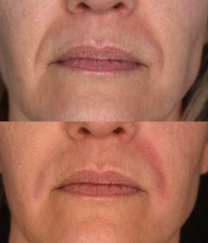 Nasolabial Fold Filler Before & After Photos | Cosmedics MedSpa in Lehi, UT