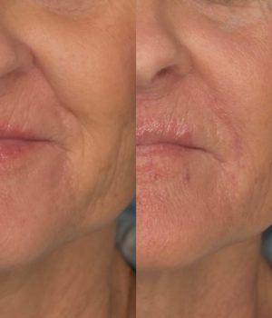 Nasolabial Fold Filler Before & After | Cosmedics MedSpa in Lehi, UT