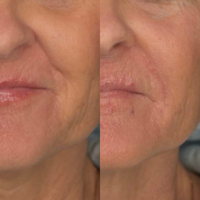 Nasolabial Fold Filler Before & After | Cosmedics MedSpa in Lehi, UT