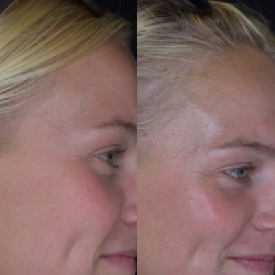 HydraFacial Before and After Photos | Cosmedics MedSpa in Lehi, UT