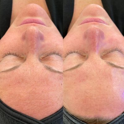 HydraFacial Before & After Photos | Cosmedics MedSpa in Lehi, UT