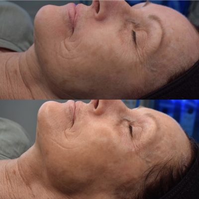 HydraFacial Before & After Images | Cosmedics MedSpa in Lehi, UT