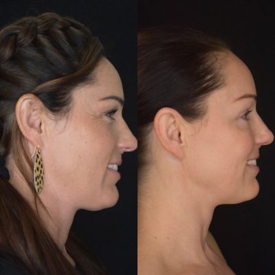 IPL Photofacial Before & After Photos | Cosmedics MedSpa in Lehi, UT