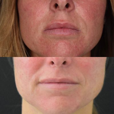 IPL Photofacial Before and After Photos | Cosmedics MedSpa in Lehi, UT