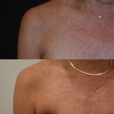 IPL Photofacial Before and After | Cosmedics MedSpa in Lehi, UT