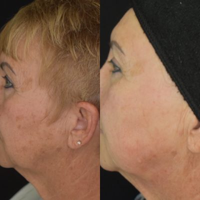 IPL Photofacial Before and After | Cosmedics MedSpa in Lehi, UT