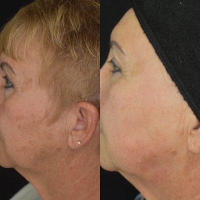 IPL Photofacial Before and After | Cosmedics MedSpa in Lehi, UT