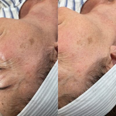 IPL Photofacial Before and After Photos | Cosmedics MedSpa in Lehi, UT