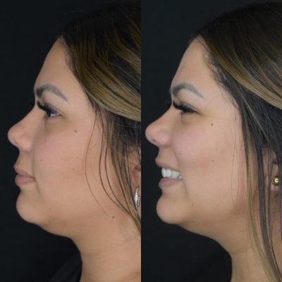 Kybella Before and After Photos | Cosmedics MedSpa in Lehi, UT