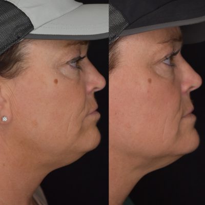 Kybella Before & After Photos | Cosmedics MedSpa in Lehi, UT