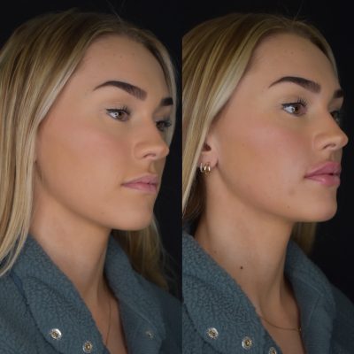 Lip Filler Before and After Photos | Cosmedics MedSpa in Lehi, UT