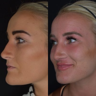 Lip Filler Before and After | Cosmedics MedSpa in Lehi, UT
