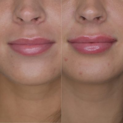 Lip Filler Before and After Images | Cosmedics MedSpa in Lehi, UT