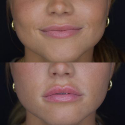 Lip Filler Before and After Images | Cosmedics MedSpa in Lehi, UT