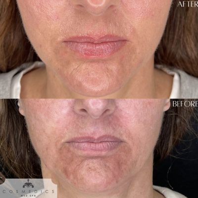 Opus Before and After Photos | Cosmedics MedSpa in Lehi, UT