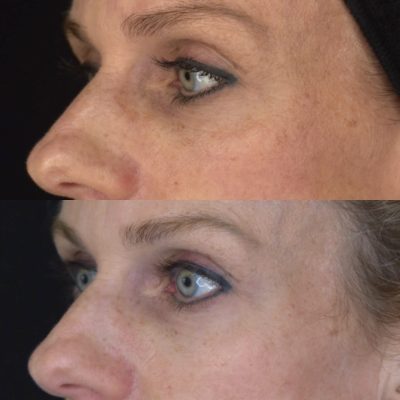 Opus Before and After Images | Cosmedics MedSpa in Lehi, UT