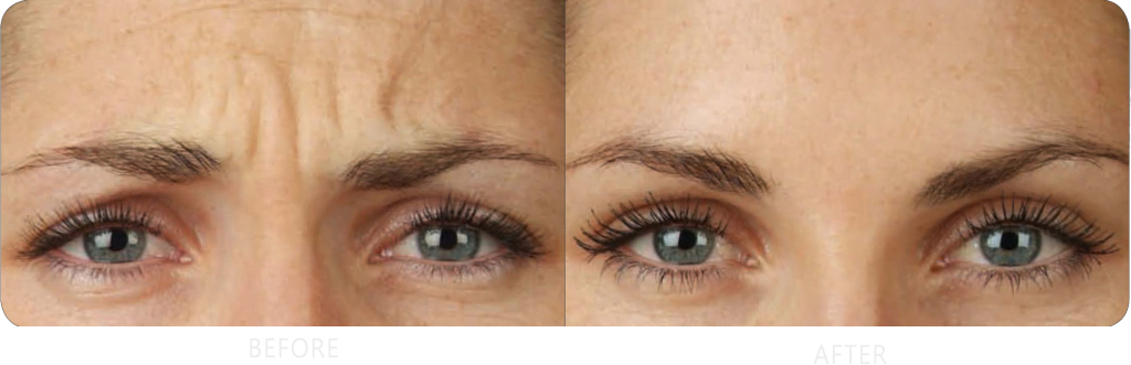 Botox brow Before & After Treatment Photos | Cosmedics MedSpa in Lehi, UT