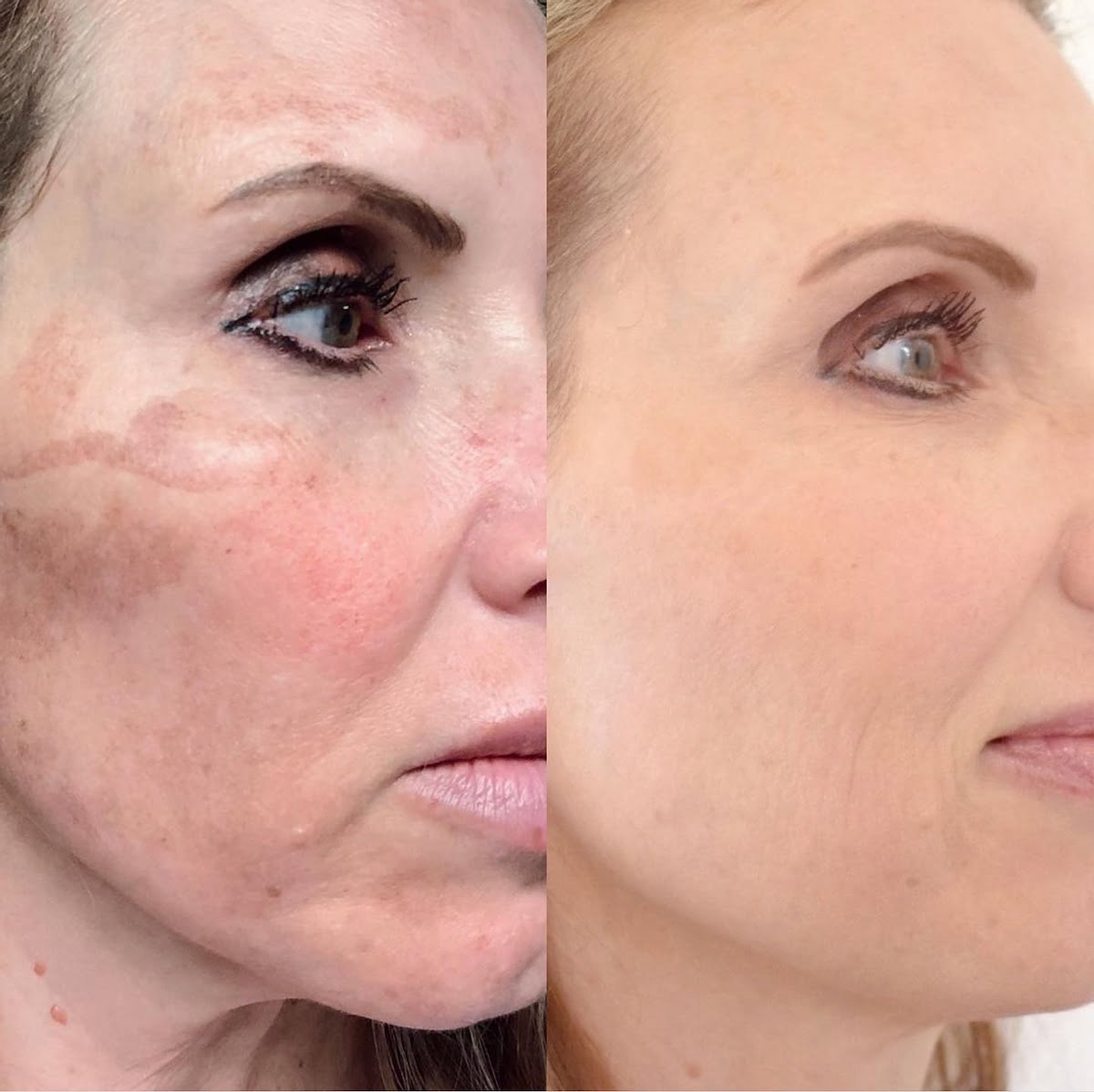 Chemical Peel Before & After Treatment Photos | Cosmedics MedSpa in Lehi, UT
