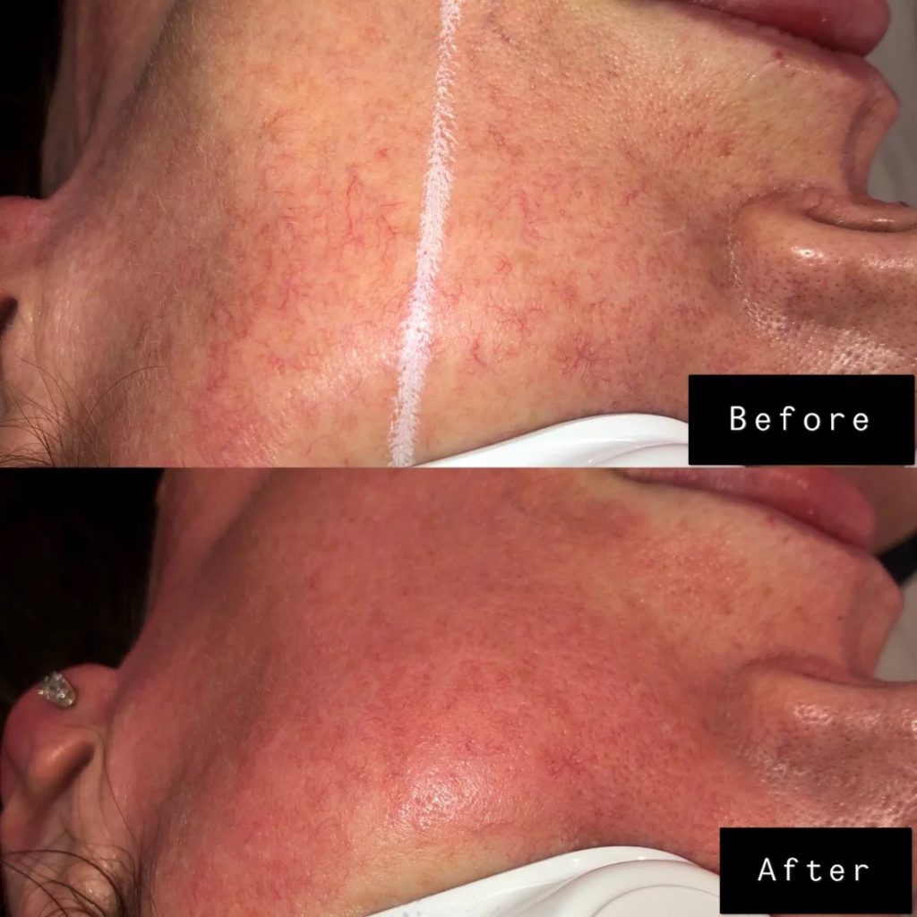 Photo facial Before & After Treatment Photos | Cosmedics MedSpa in Lehi, UT