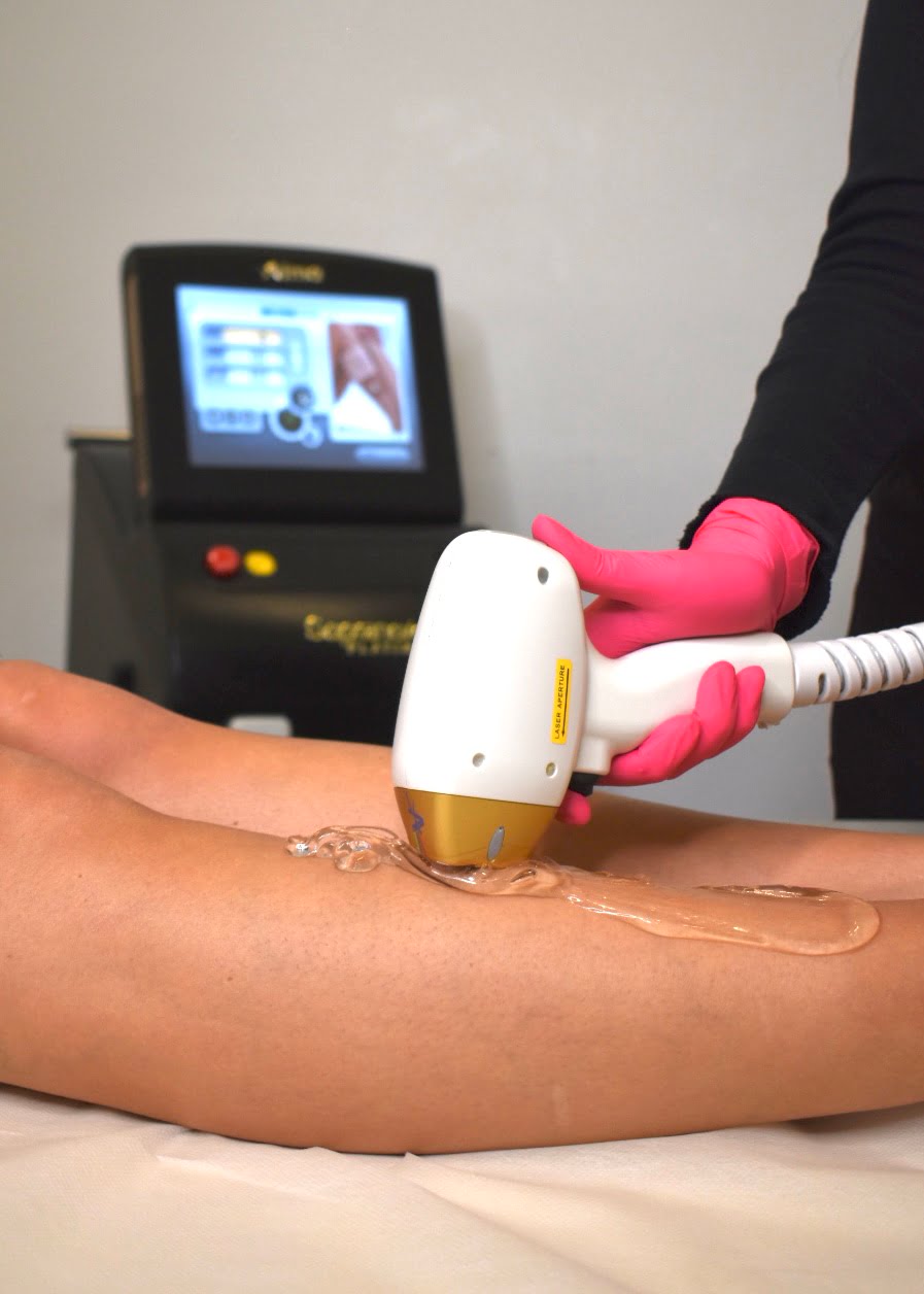 Patient Getting Laser Hair Removal Treatment on Legs | Cosmedics MedSpa in Lehi, UT