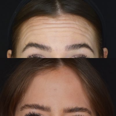 Botox Before and After Photos | Cosmedics MedSpa in Lehi, UT