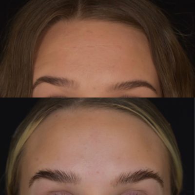 Botox Before and After Images | Cosmedics MedSpa in Lehi, UT