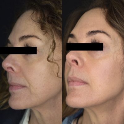Opus Before and After | Cosmedics MedSpa in Lehi, UT