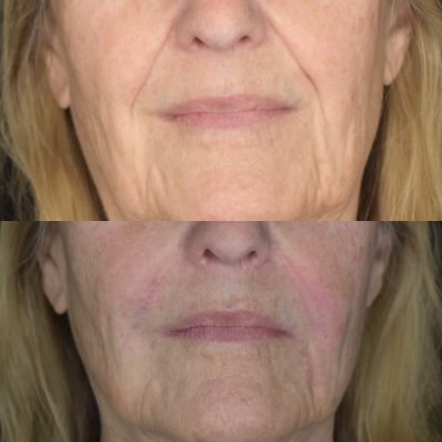 Nasolabial Fold Filler Before & After Treatment Photos | Cosmedics MedSpa in Lehi, UT