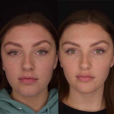 Cheek Filler Before & After | Cosmedics MedSpa in Lehi, UT