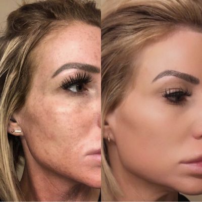 Chemical Peels Before and After Photos | Cosmedics MedSpa in Lehi, UT