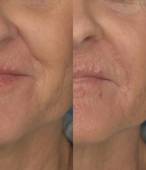 Nasolabial Fold Filler Before & After | Cosmedics MedSpa in Lehi, UT