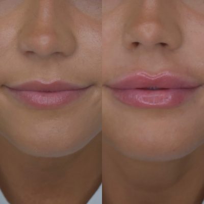 Lip Filler Before & After Photos | Cosmedics MedSpa in Lehi, UT
