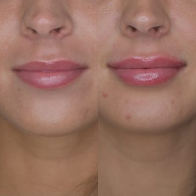 Lip Filler Before and After Images | Cosmedics MedSpa in Lehi, UT